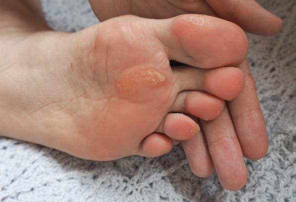 podologia y quiropodia en clinica fisan madrid